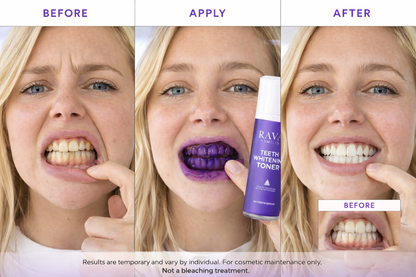 Veneer & Bonding Aftercare Kit