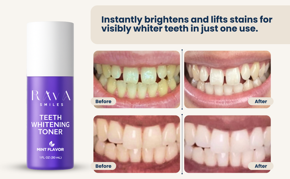 Veneer & Bonding Aftercare Kit